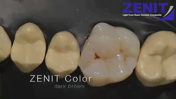 SECOND CLASS RESTORATION with ZENIT Nano Ceramic Composite!