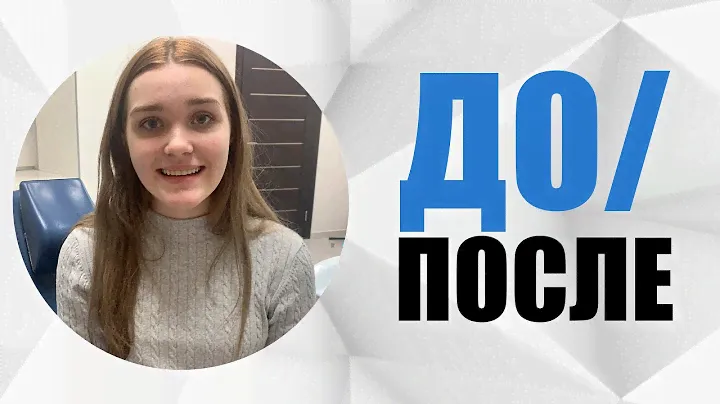 #10 случай до/после. Исправление медиального прикуса без операции [ брекеты Experience Ceramic ].