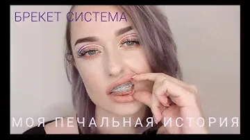 Мои БРЕКЕТЫ. ответы на вопросы про брекет систему, опыт, лечение зубов. как выбрать ортодонта