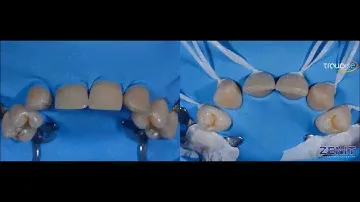 Zenit Nano Ceramic Composite ( President Dental Study Club)